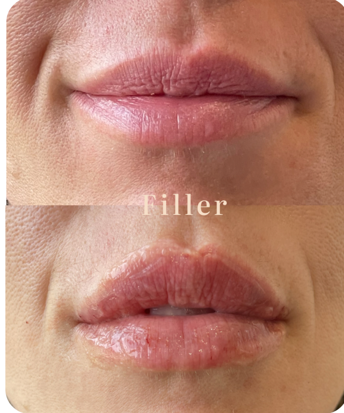 Close-up of lips showing before and after lip filler treatment with the word 'Filler' in the center.