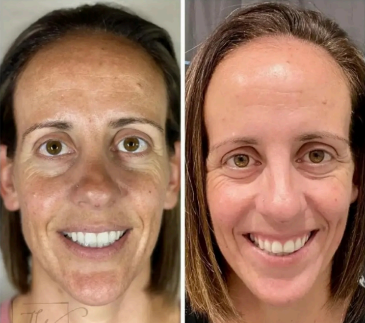 Side-by-side comparison of a woman's face before and after RF microneedling treatment, showing improved skin texture and reduced wrinkles.