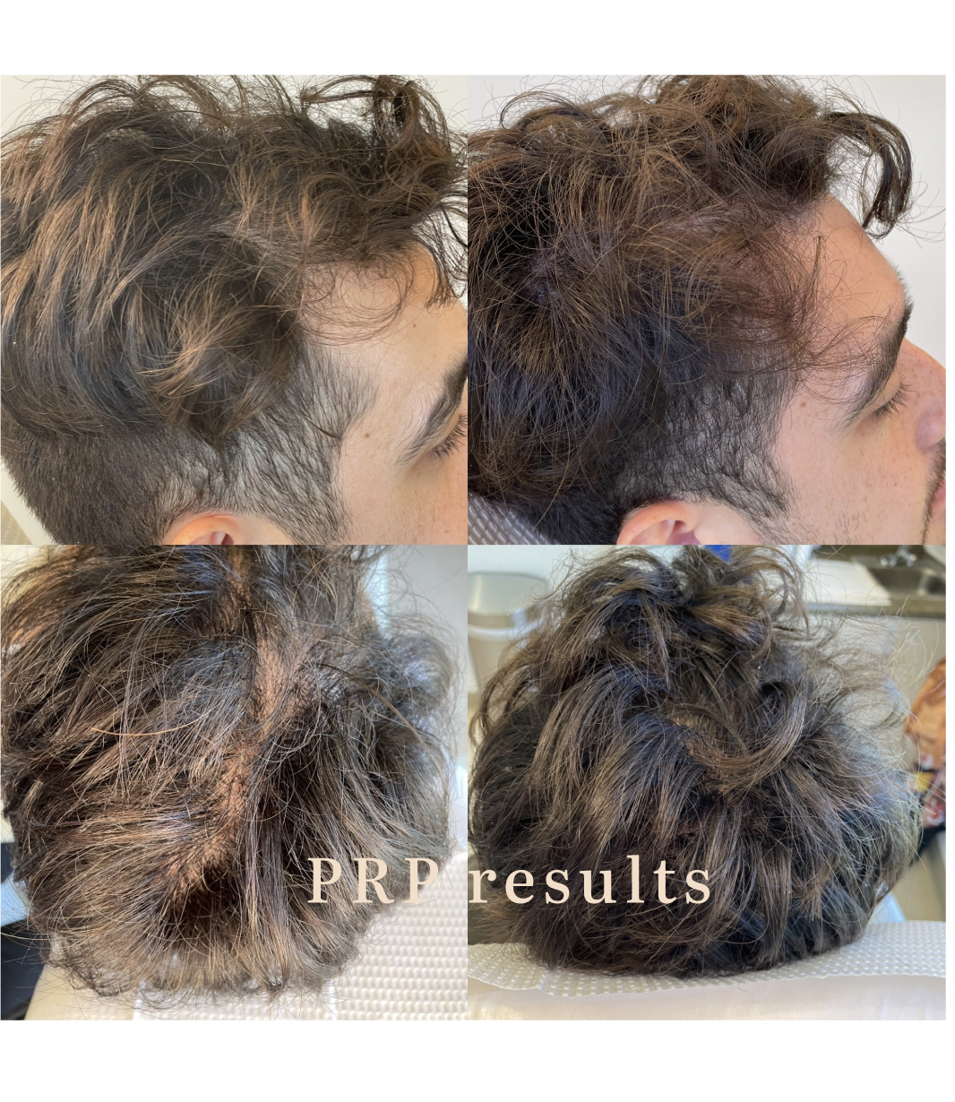 Collage of four photos showing the before and after results of a PRP treatment on a person's scalp and hair, highlighting improved hair density and hair growth.
