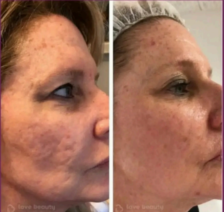 Close-up of a woman's face before and after RF microneedling treatment, showing reduced wrinkles and smoother skin on the right.