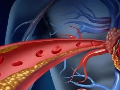 September is National Cholesterol Education Month: What You Need to Know
