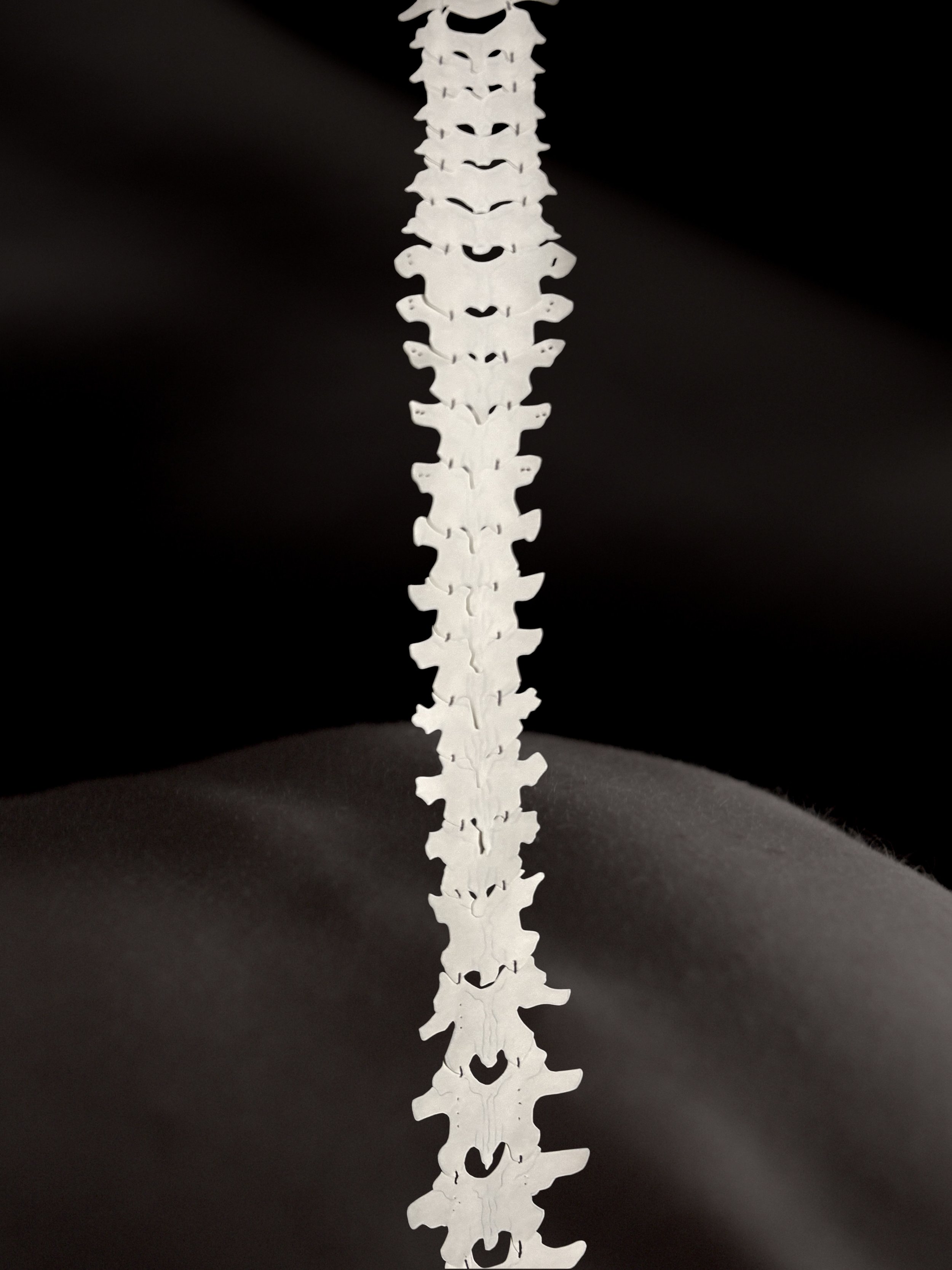 Spinal Tether Print