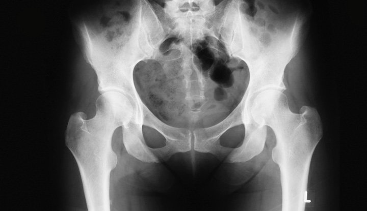 Lessons from my hip