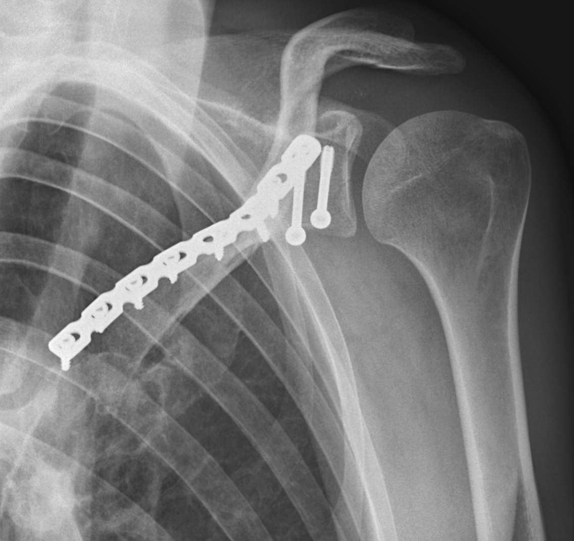 X-ray of a shoulder with a metal surgical plate and screws used for medical fixation.