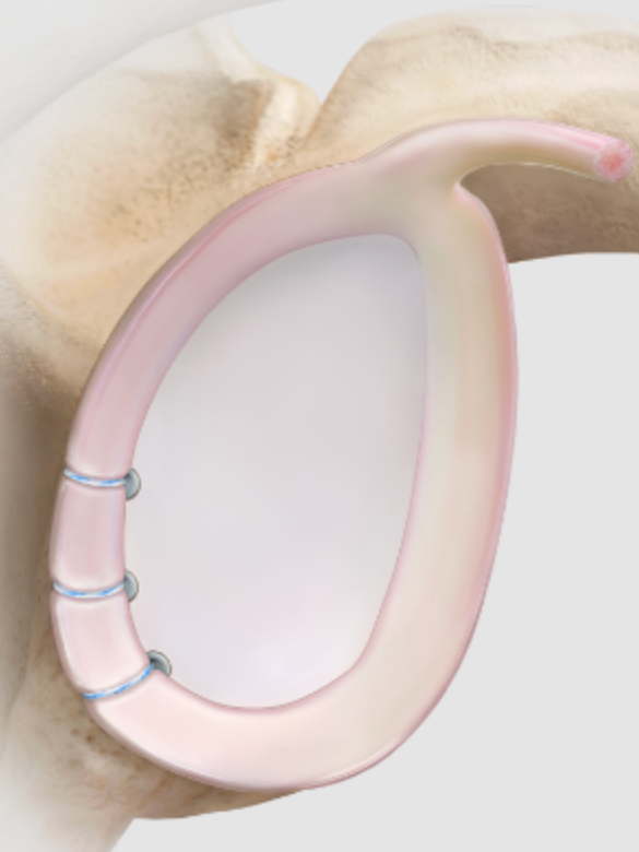 A close-up view of an ear with a pink cochlear implant attached to the inner ear.