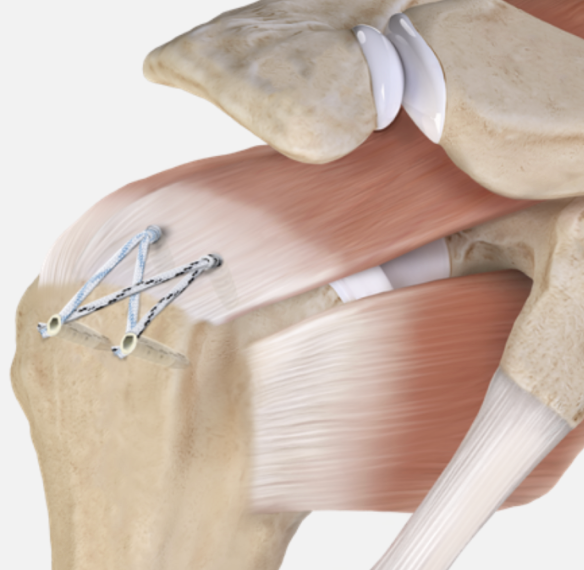 Close-up of a human knee joint showing bones, ligaments, cartilage, and muscles with surgical screws and sutures.