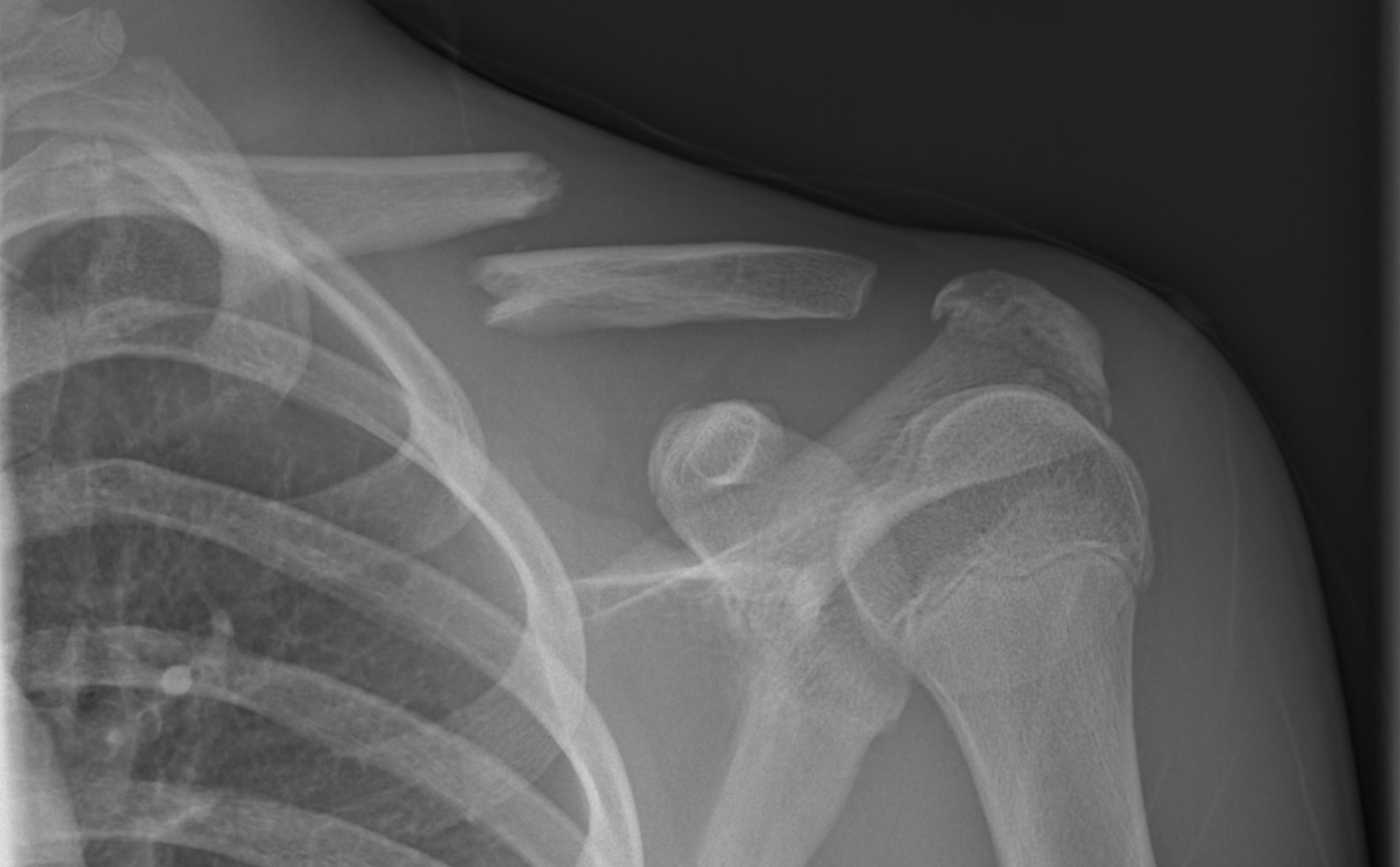 X-ray image of a shoulder showing fractured clavicle, scapula, and humerus bones.