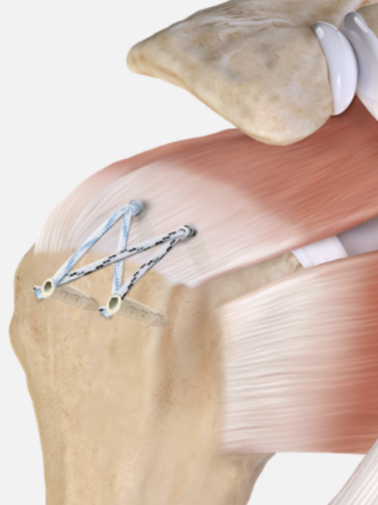 Medical illustration of shoulder muscles, tendons, and surgical sutures.