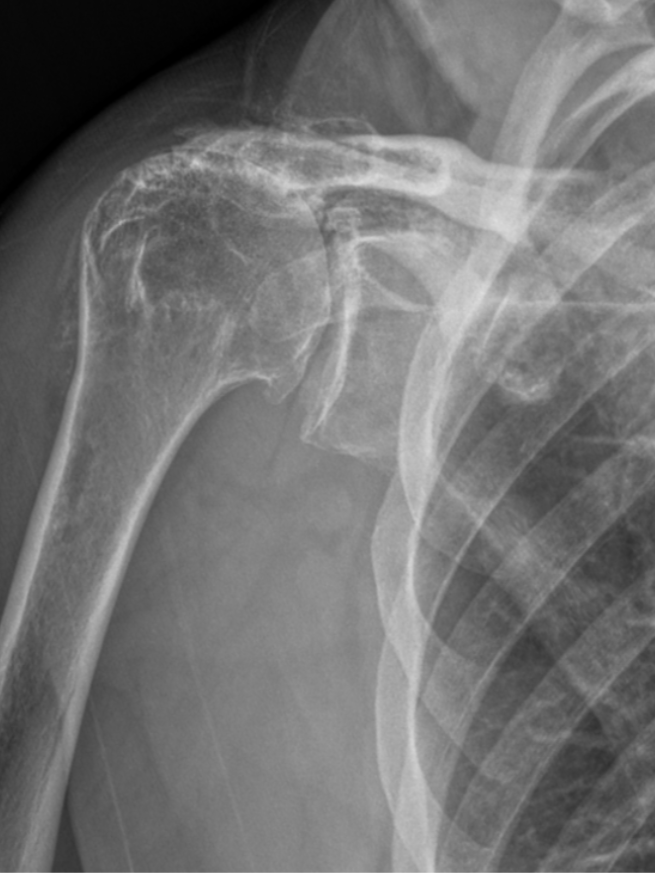 X-ray image of a human shoulder showing the humerus, scapula, and clavicle bones.