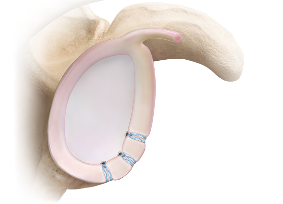 Medical illustration of a shoulder joint with a shoulder implant, showing the implant attached to the shoulder bones with sutures.
