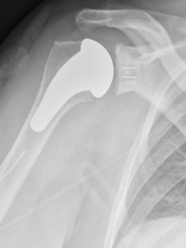 X-ray of a shoulder with a hip replacement prosthesis.