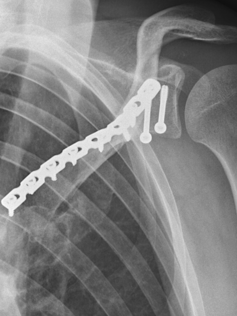 X-ray image of a shoulder showing a metal plate and screws attached to the collarbone.