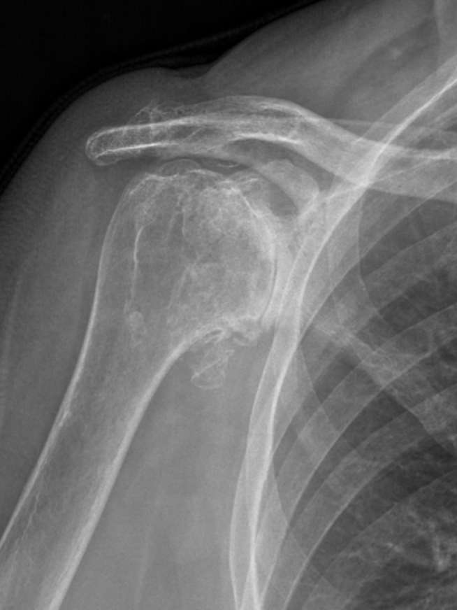 X-ray image of a shoulder joint showing a fracture in the humerus near the shoulder socket.