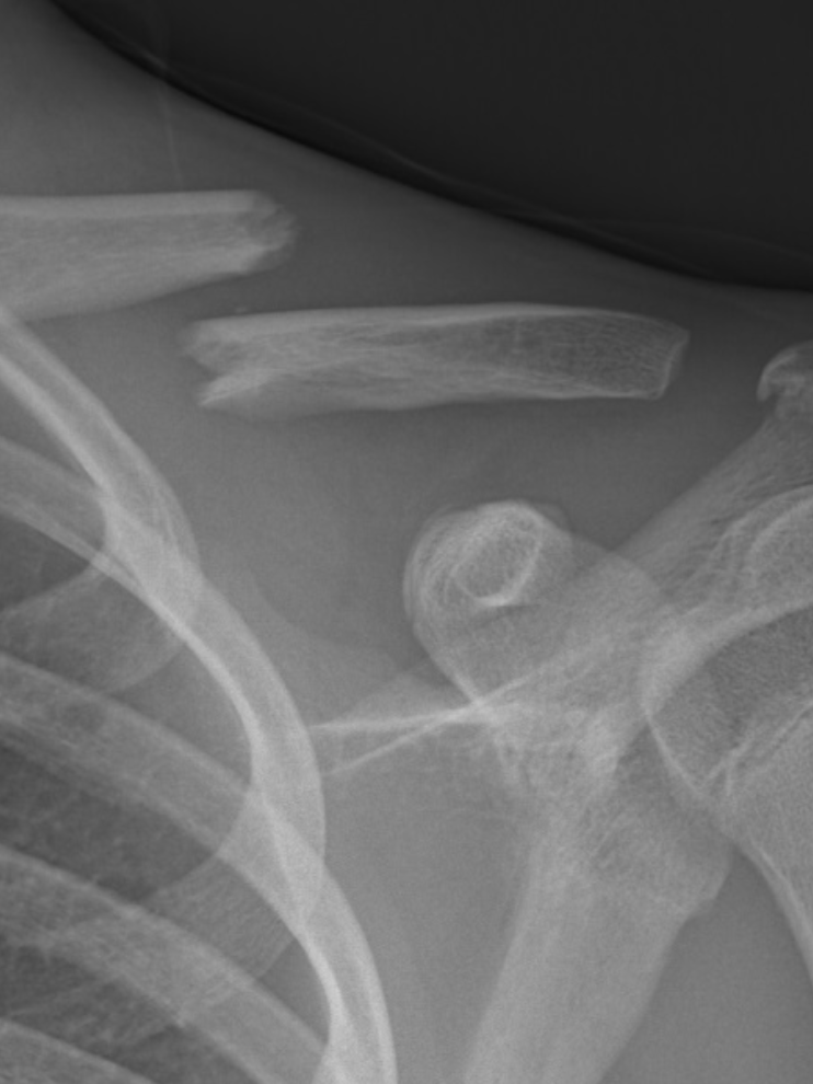 X-ray image showing broken and dislocated shoulder bones.