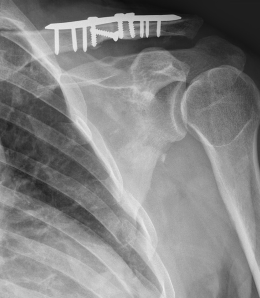 X-ray of shoulder with metal plate and screws in the clavicle.