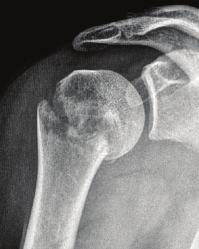 X-ray image of a shoulder joint with a fractured humerus.