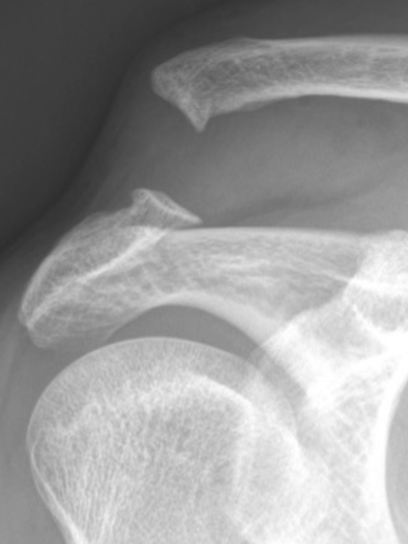 X-ray image of a shoulder showing the clavicle, scapula, and humerus bones.