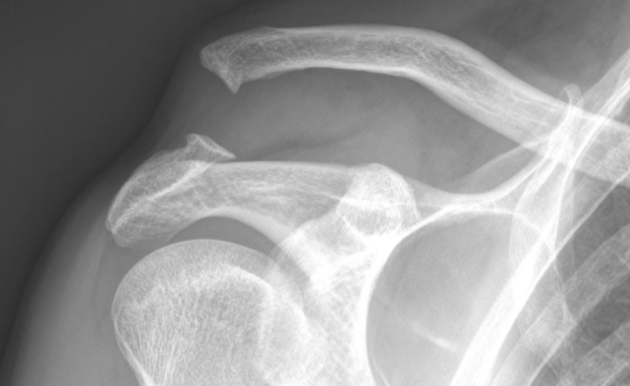 X-ray image of a shoulder joint showing broken clavicle and fractured humerus.