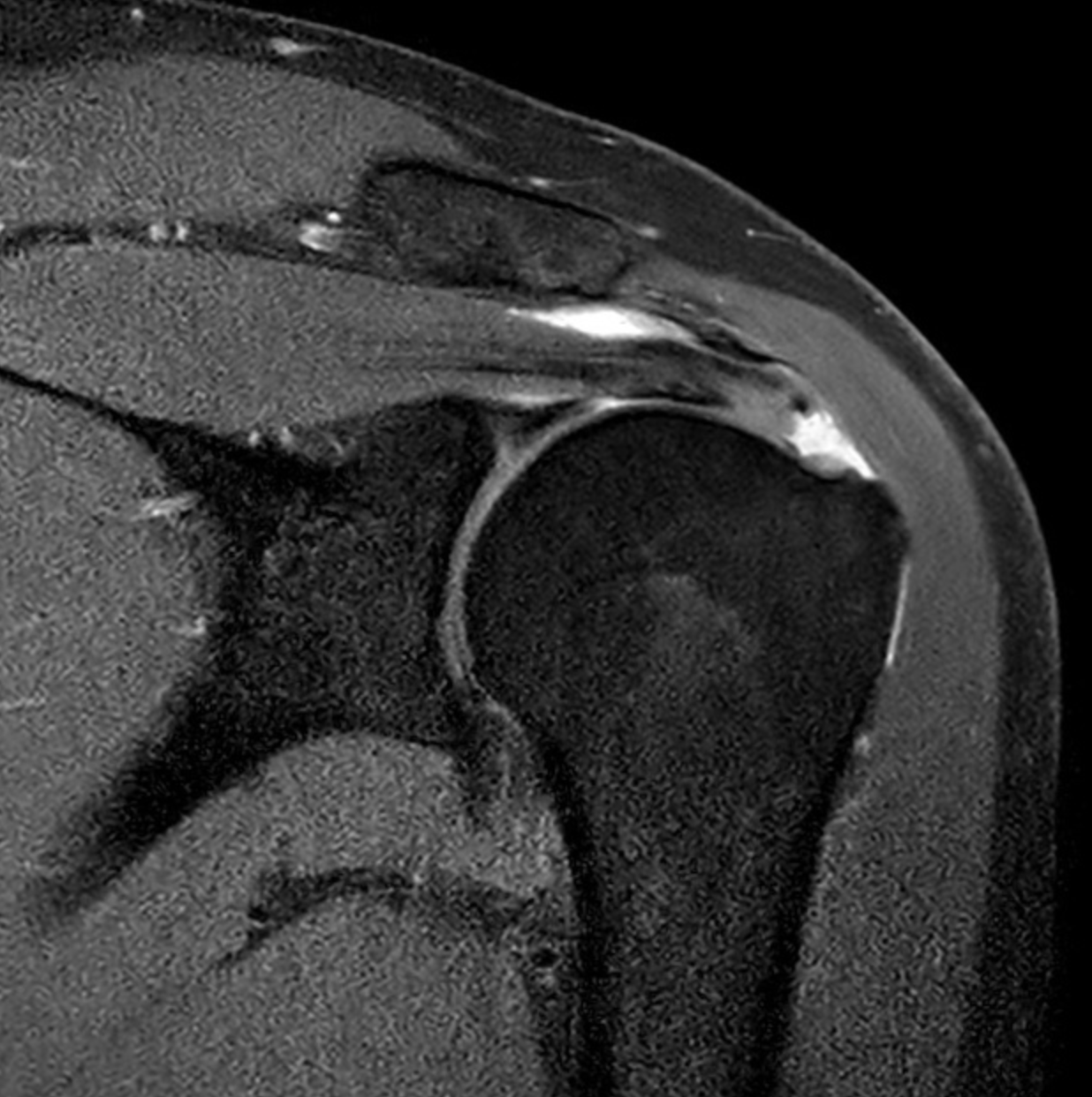 A black-and-white, grainy photo of a person's face reflected in a glass of water, creating a distorted, artistic effect.