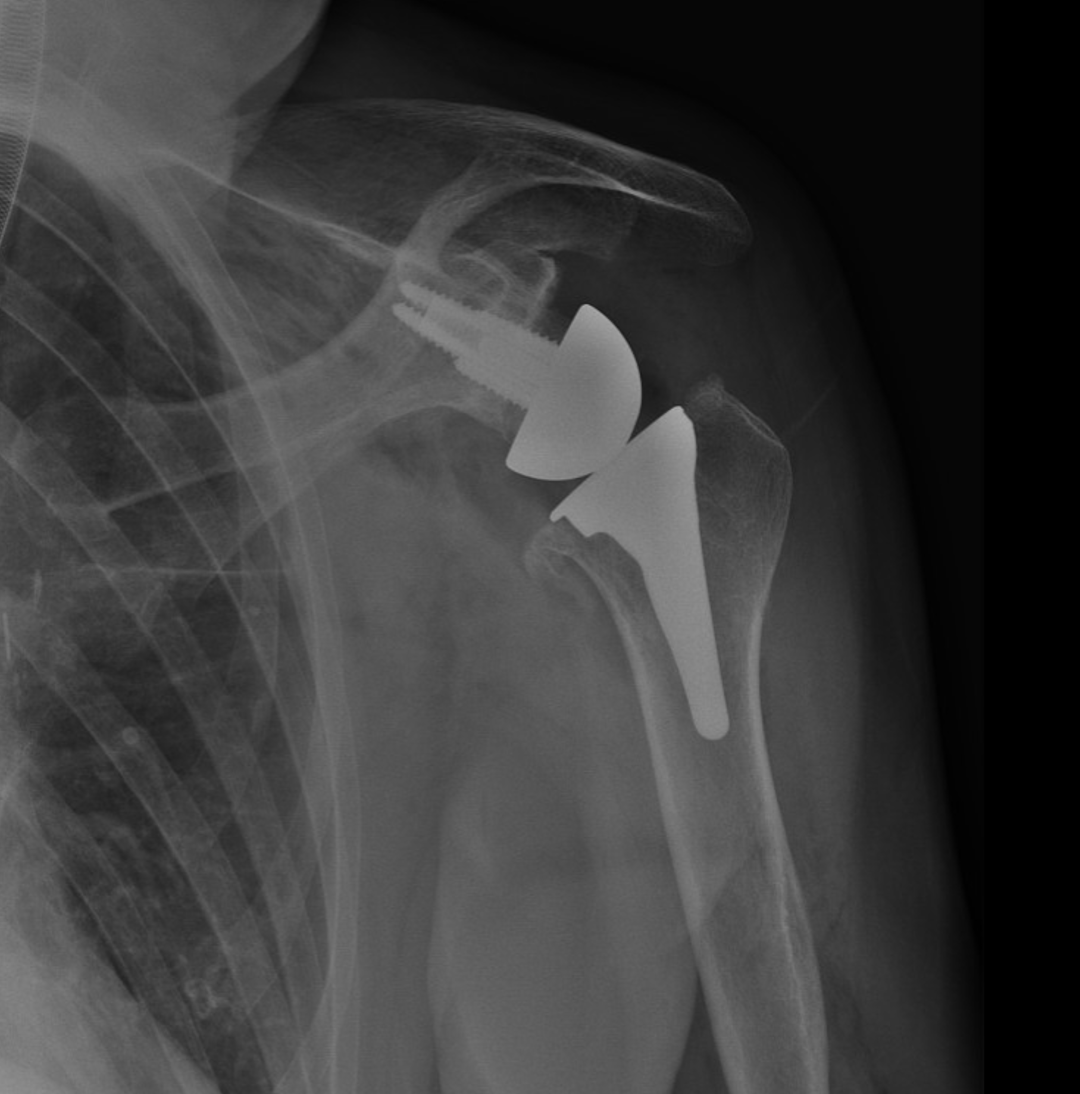 X-ray image of a shoulder with a shoulder replacement implant, including a metal humeral stem and a cup in the shoulder socket.