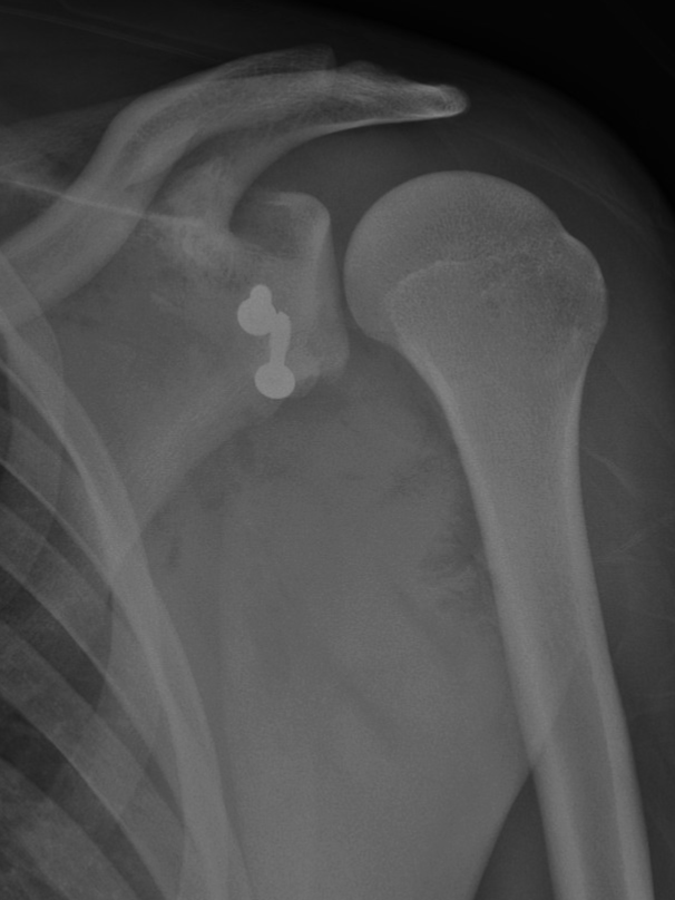 X-ray of a shoulder showing a broken humerus with two metal screws.
