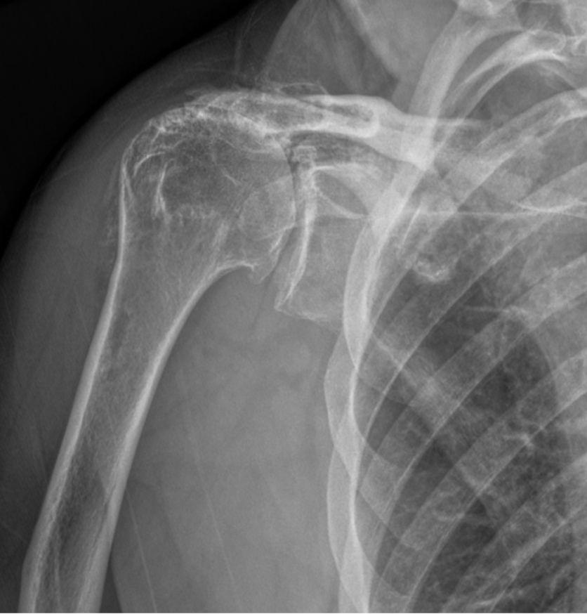 X-ray image of a human shoulder showing the clavicle, scapula, and upper arm bone (humerus).