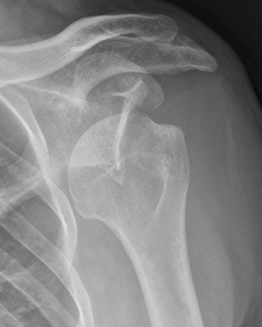 X-ray image of a shoulder joint showing the clavicle, scapula, and humerus.