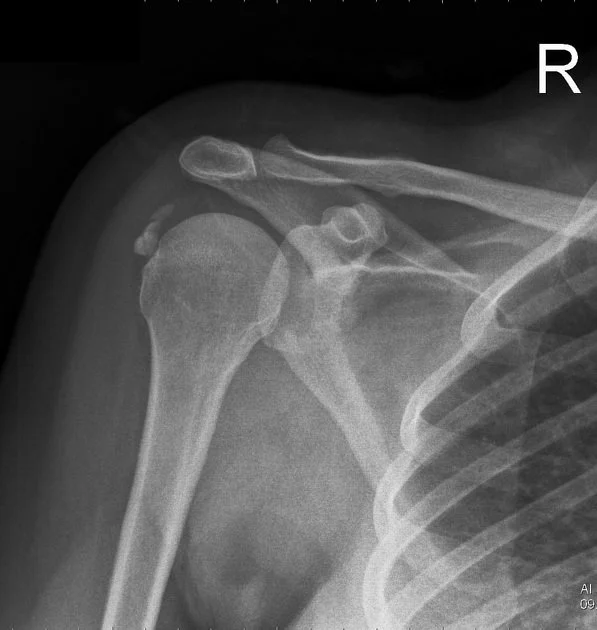 X-ray image of a right shoulder showing a fractured clavicle and dislocated humeral head.