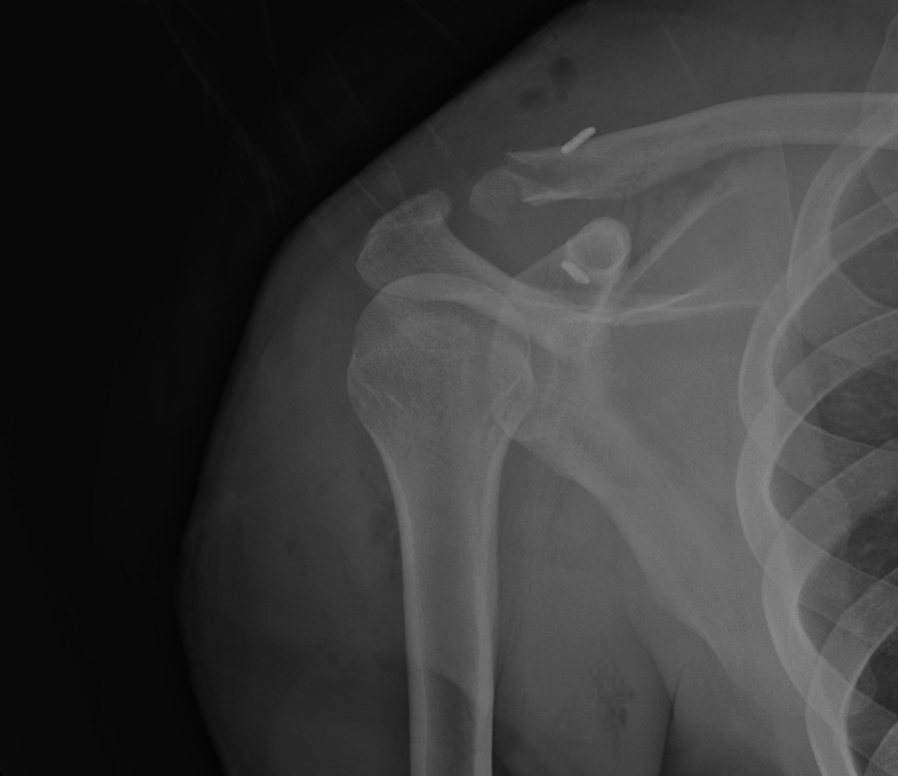 X-ray of a shoulder showing a broken clavicle, with magnetic metal pins placed to stabilize the fracture.