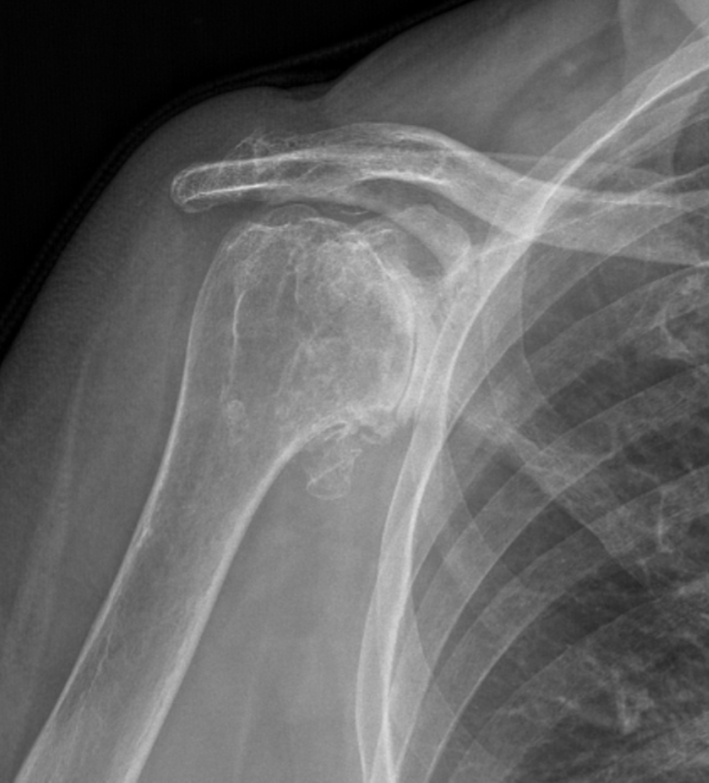 X-ray image of a shoulder showing a broken clavicle with possible shoulder dislocation.