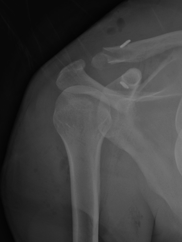 X-ray image of a shoulder showing a broken humerus and fractured clavicle with a pin in place.