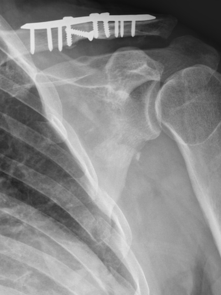 X-ray image of a shoulder showing a metal plate and screws used to repair a fracture.