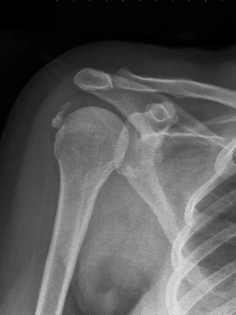 X-ray image of a shoulder showing a broken clavicle and shoulder joint.