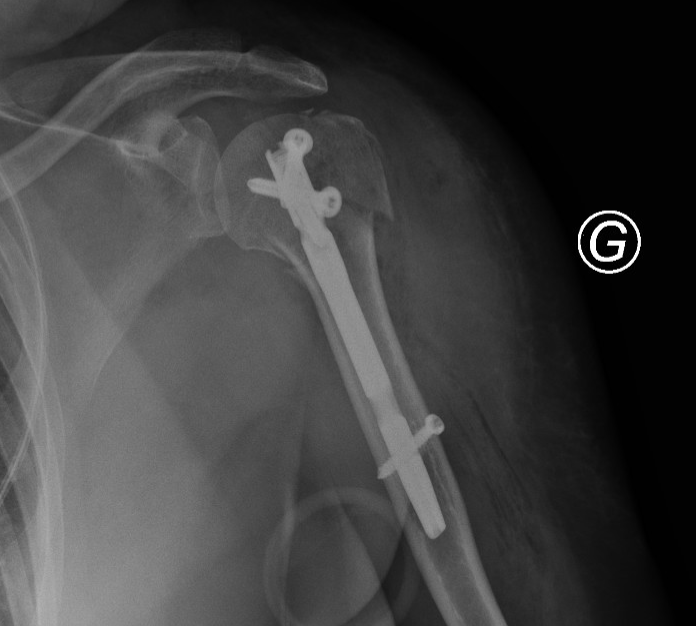 X-ray of a broken femur with surgical metal rod and screws for stabilization.