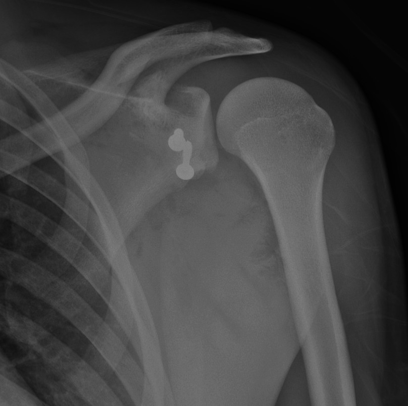 X-ray showing a shoulder with a shoulder implant and a small object near the joint.