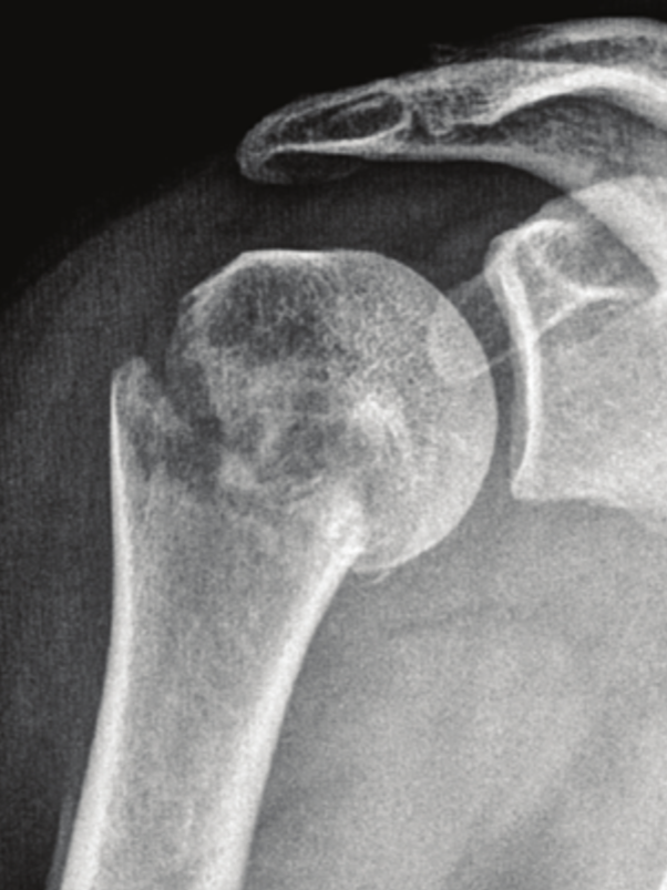 X-ray image of a shoulder involving the humerus and scapula.