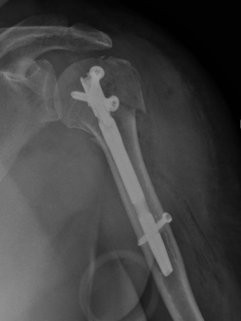 X-ray image of a human shoulder and upper arm showing a surgical metal rod and screws in the humerus bone.