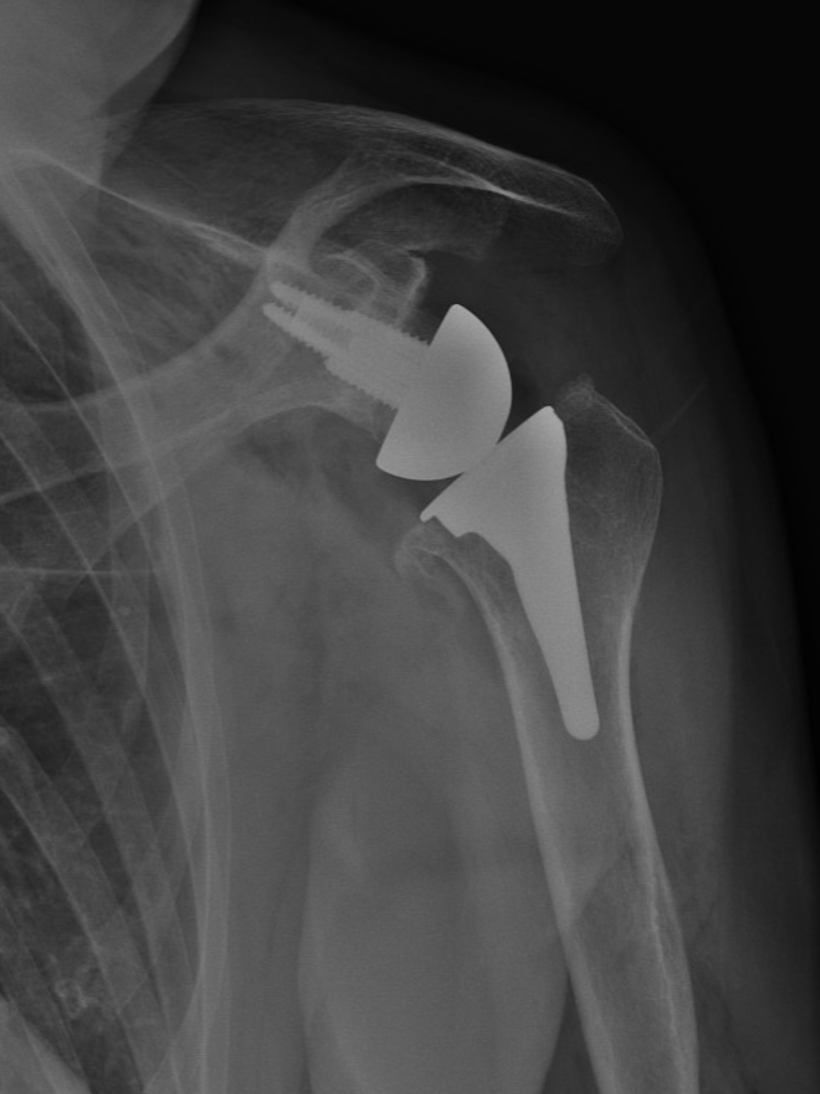 X-ray image showing a shoulder with artificial joint components, including a metal prosthesis.