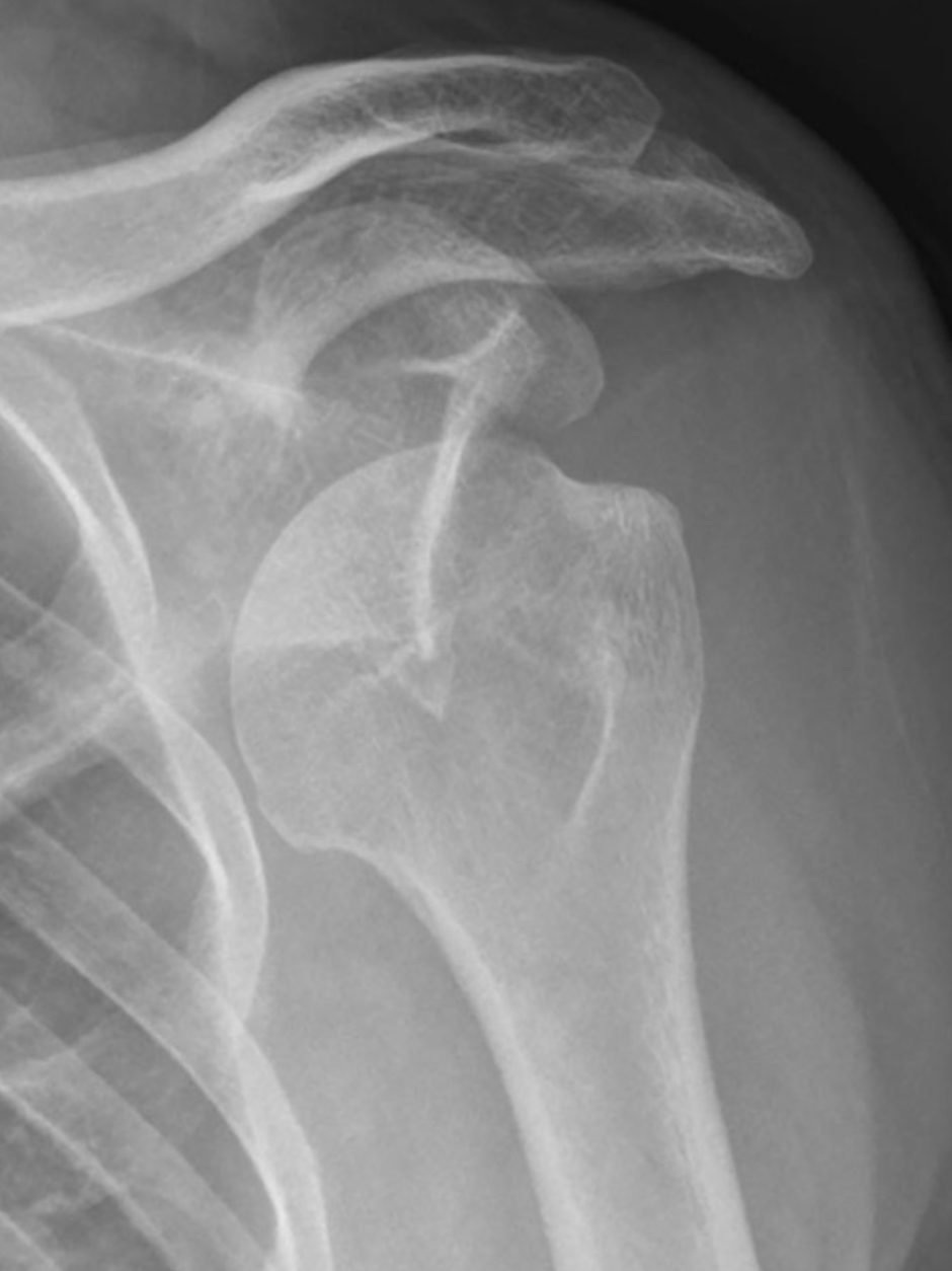 X-ray image of a shoulder joint showing the humerus and scapula bones.
