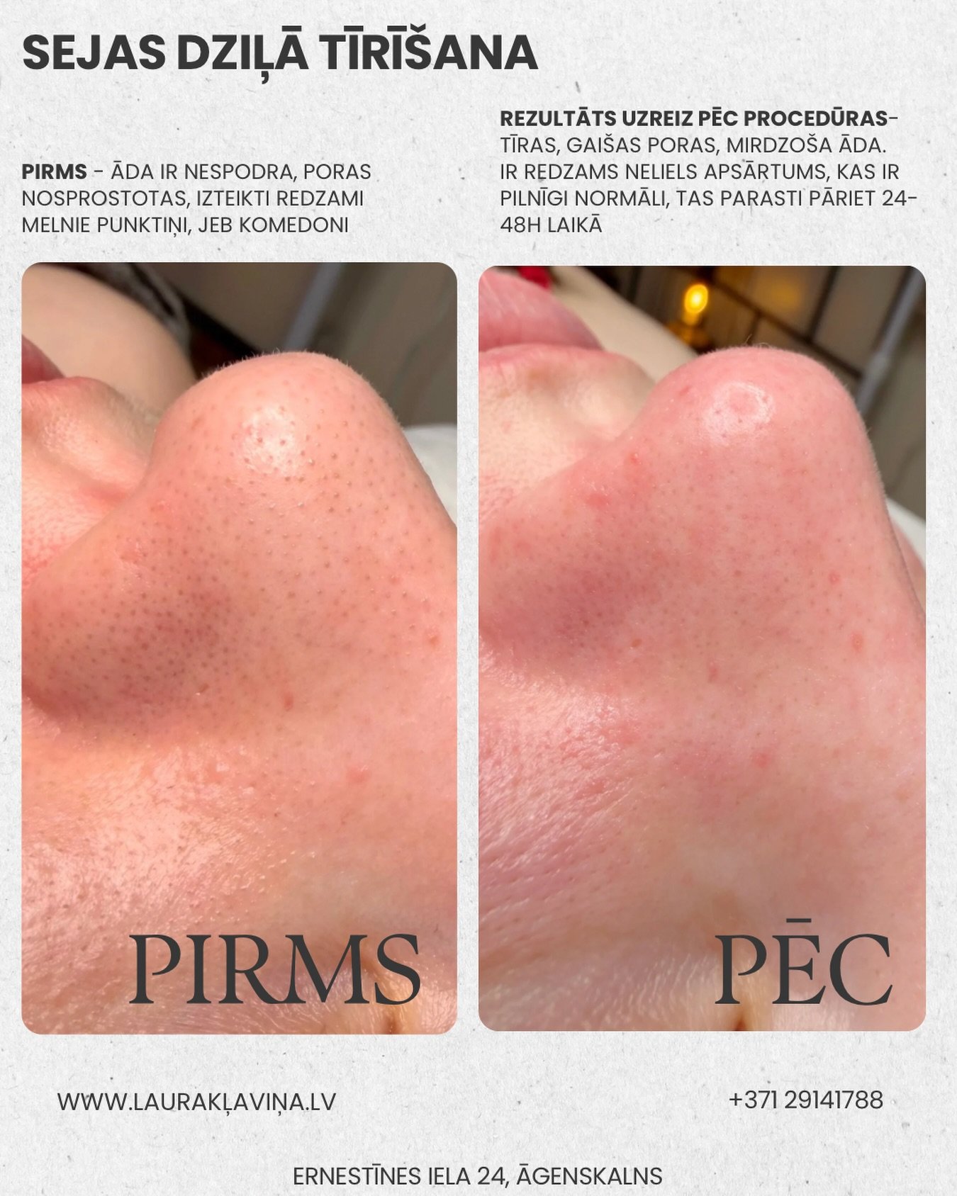 ✨Sejas dziļā jeb mehāniskā tīrī&scaron;ana palīdz attīrīt poras no nosprostojumiem un uzlabot ādas tekstūru.
Apsārtums pēc procedūras parasti pāriet 24-48 h laikā.

📍 Āgenskalns, Ernestīnes iela 24
 📩Online pieraksts - https://www.lauraklavina.lv/s