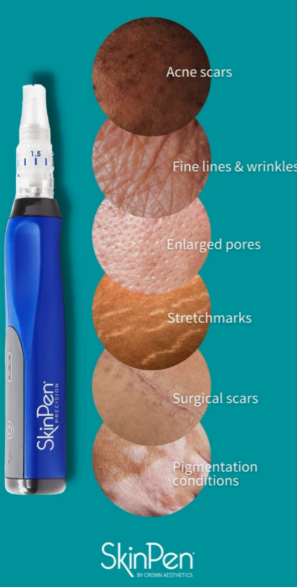 SkinPen® MicroNeedling