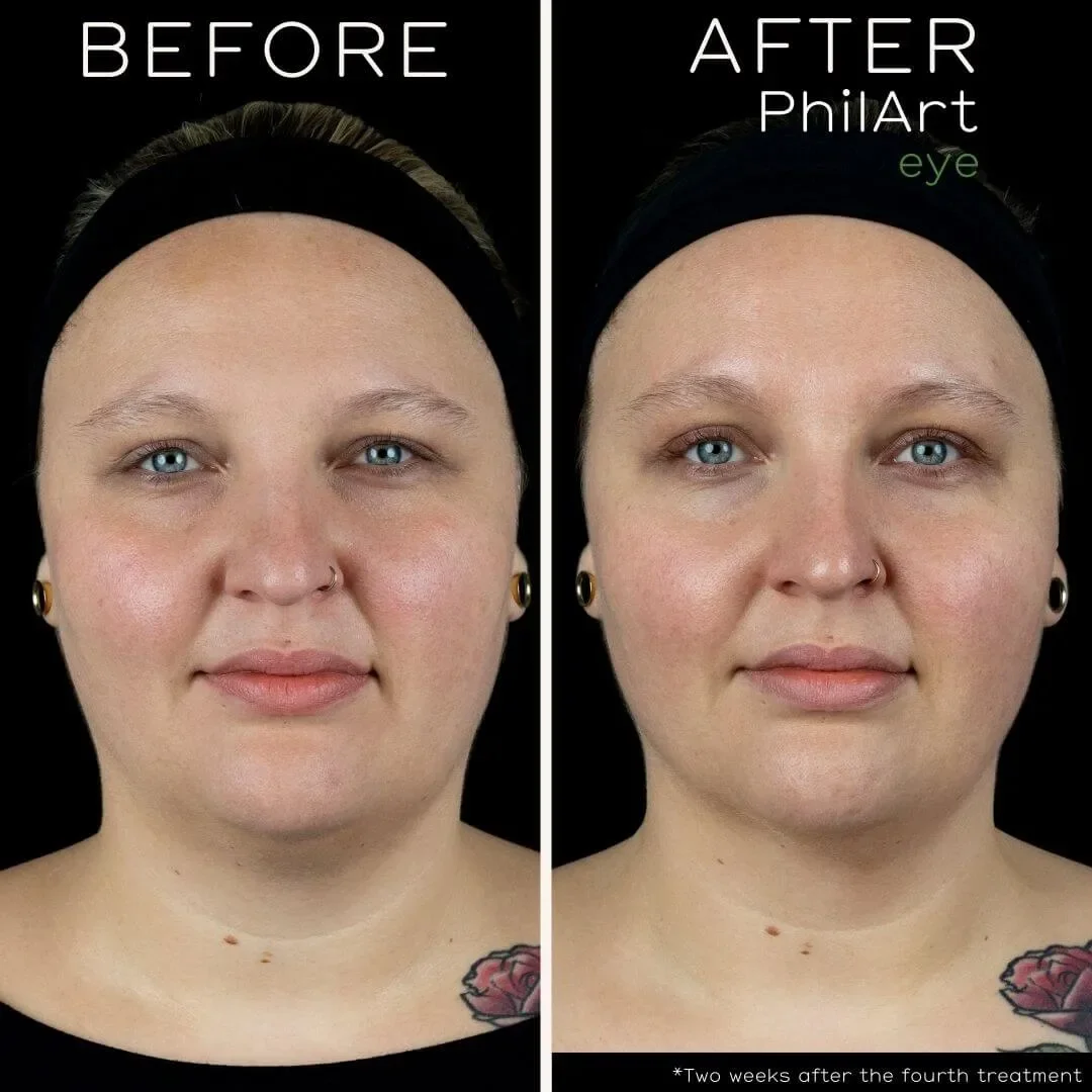 PhilArt-rejuvenation.webp