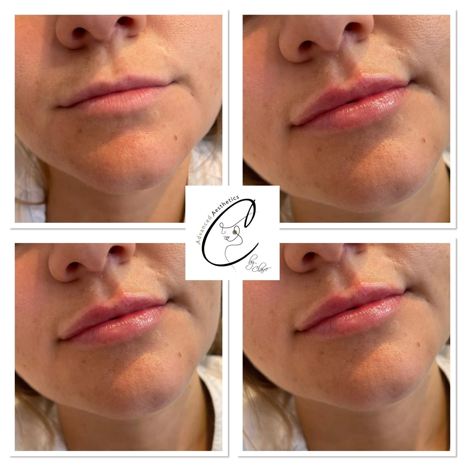 Dermal Filler