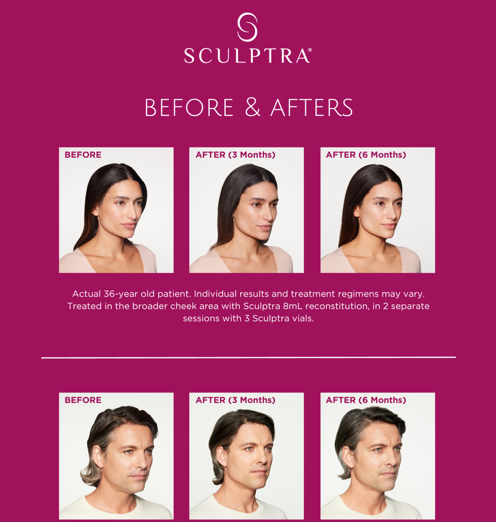 Sculptra 5.png