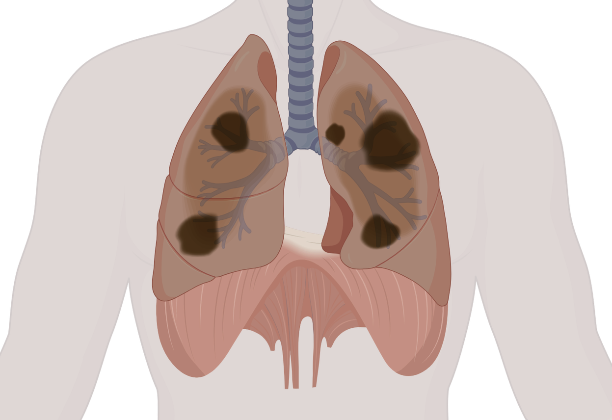 Illustration médicale des poumons et des muscles thoraciques avec des taches sombres sur les poumons.