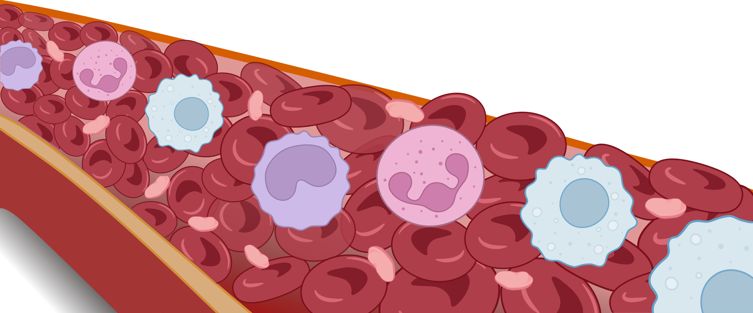 Illustration de globules rouges, globules blancs, et plaquettes dans une artère obstruée par une plaque d'athérome.