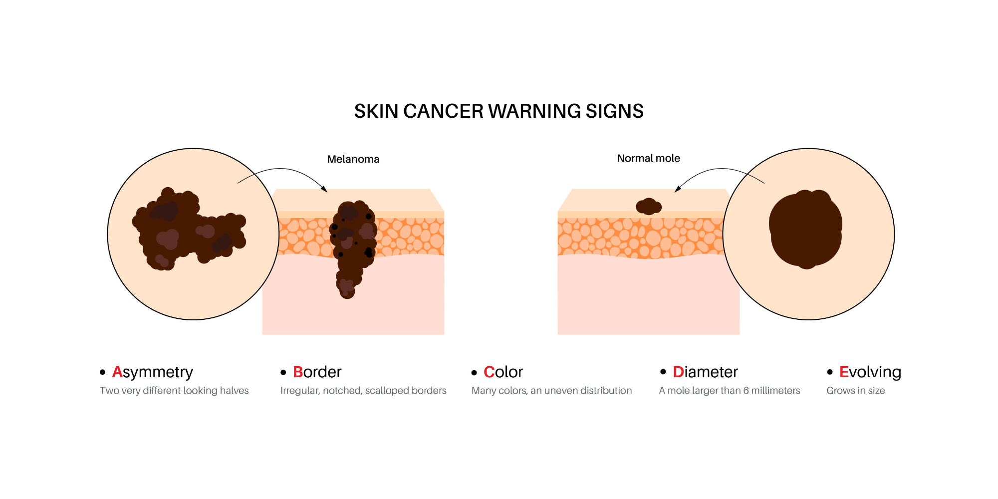 Types of Skin Cancer