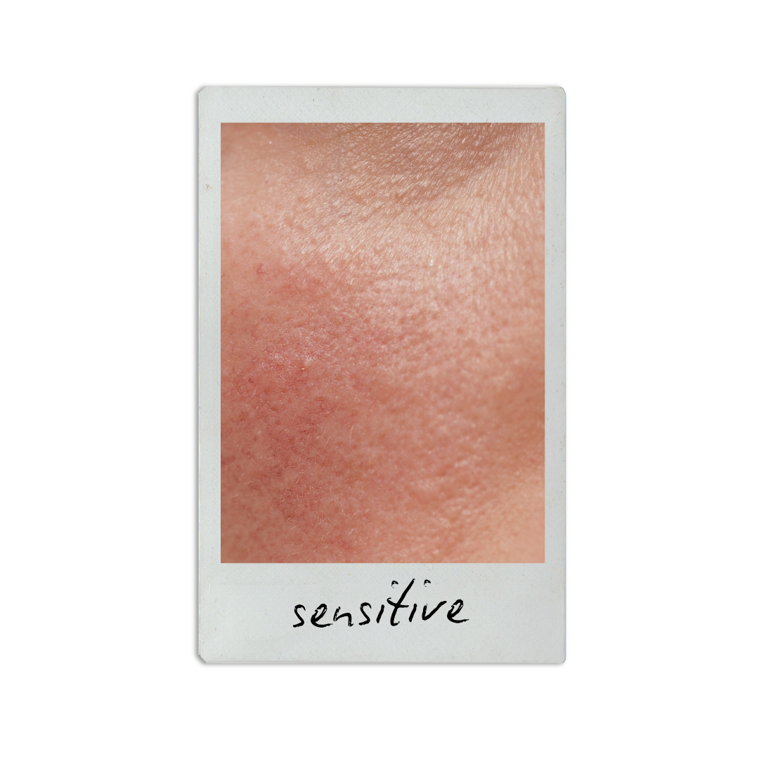 Close-up photo of sensitive skin on a person's face, showing texture and redness, with handwritten word "sensitive" at the bottom.