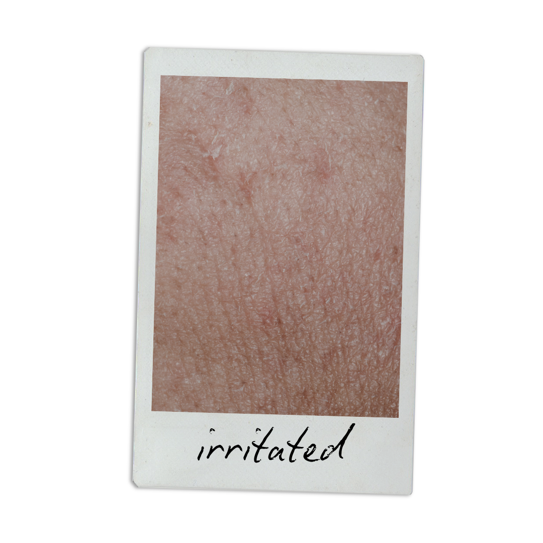 Close-up of person's skin showing irritation, with the word 'irritated' handwritten at the bottom.