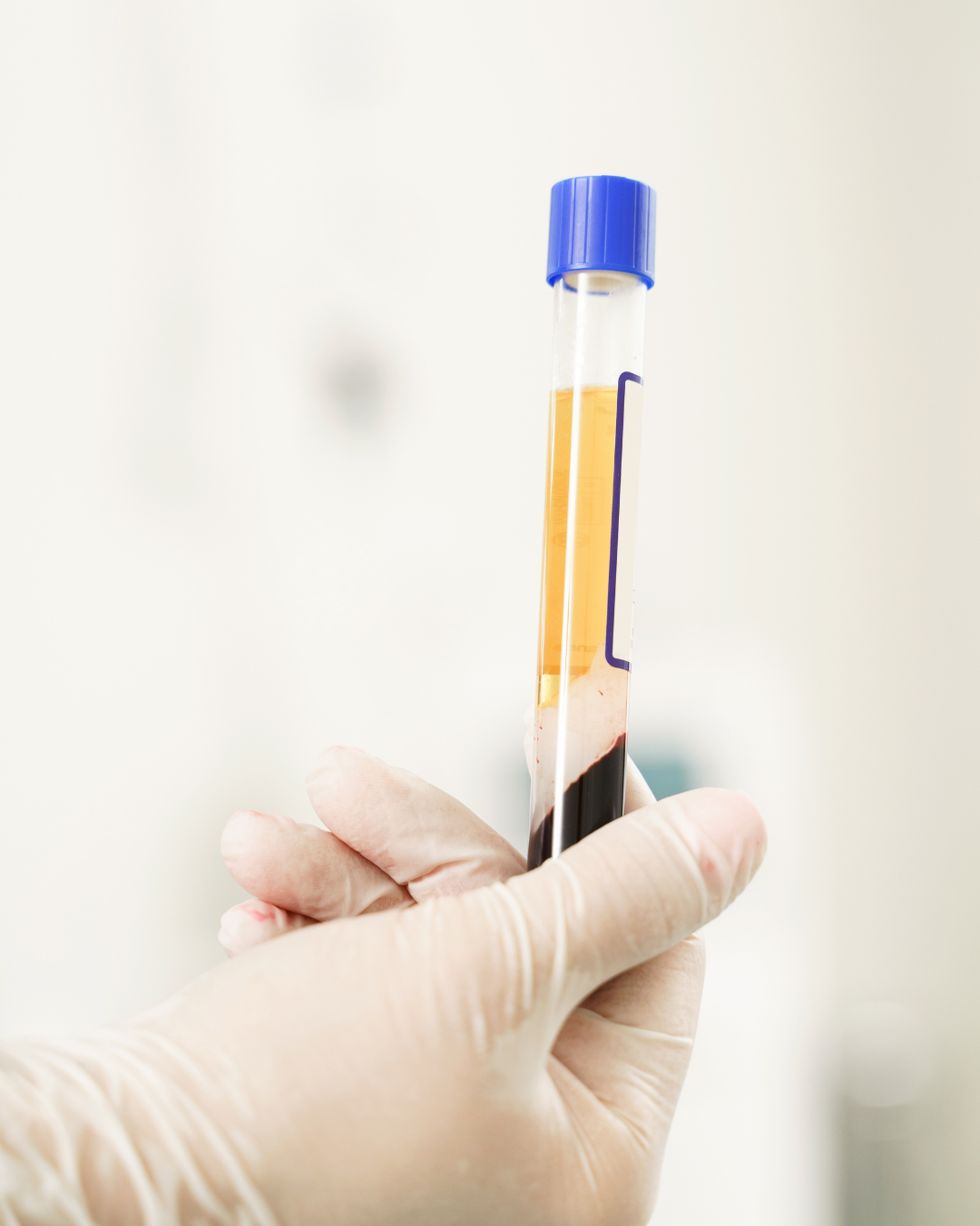 Microneedling with PRF and Exosomes